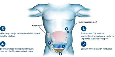 Device-based therapy for decompensated heart failure: An updated review of devices in development based on the DRI2P2S classification